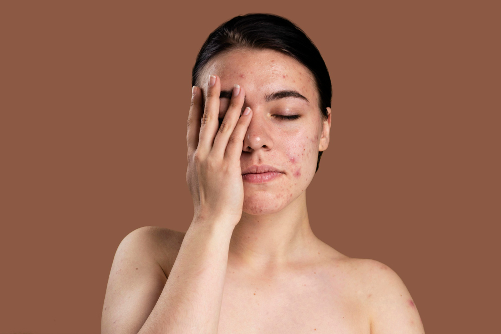 Psoriasis dan Hubungannya dengan Microbiome Usus